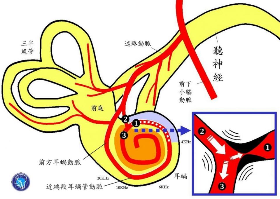 中央段耳蝸管動脈之遠端入口①發生狹窄，影響3～4千Hz處的耳蝸管(紫色區)，原本從後方耳蝸動脈②來的血流，大量轉向進入遠端段耳蝸管動脈③，產生搏動性耳鳴(橙色區)。（醫師陳建志提供）