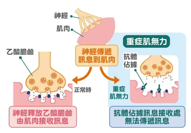 什麼是重症肌無力？