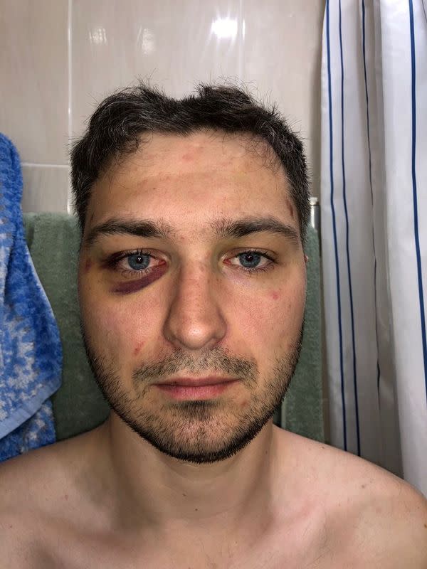 Belarusian software engineer Max Korolevsky demonstrates bruises on his body in Minsk