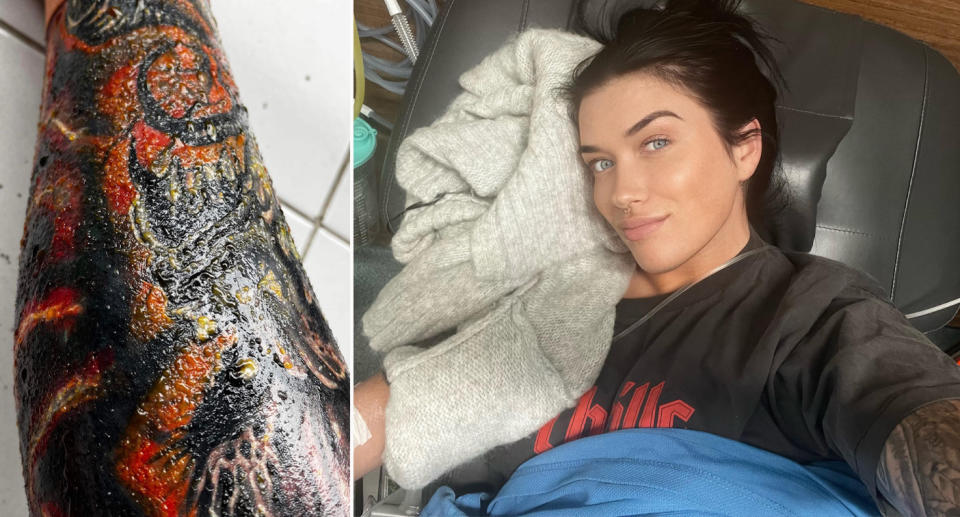 Kelsey Foster in hospital with infected leg tattoo.