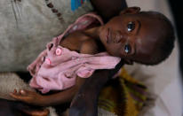 A severely acute malnourished and internally displaced Congolese child waits to receive medical attention at the Tshiamala general referral hospital of Mwene Ditu in Kasai Oriental Province in the Democratic Republic of Congo, March 15, 2018. Picture taken March 15, 2018. REUTERS/Thomas Mukoya