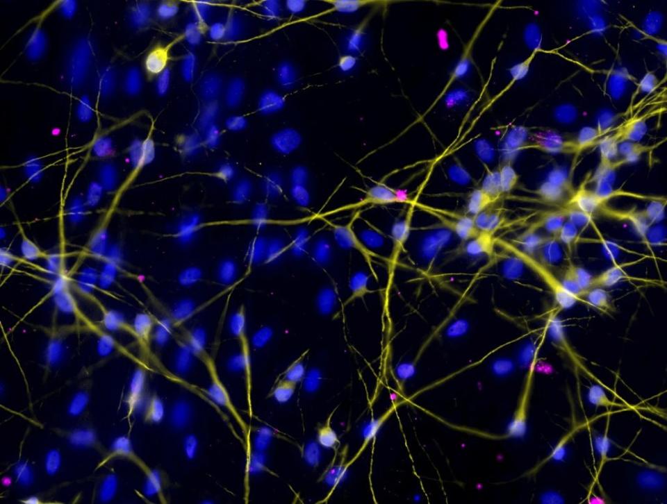 使用 ZIKV-LAV 感染的培養人類神經元。感染部分呈粉紅色，細胞核呈藍色。（圖片提供：杜克-國立大學醫學院）