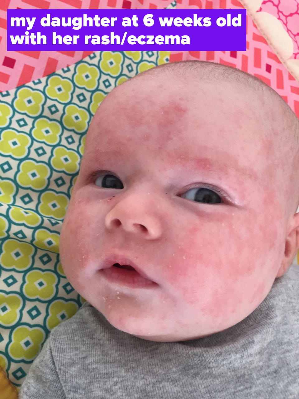 6 week old baby with splotchy, raised eczema/rash patches