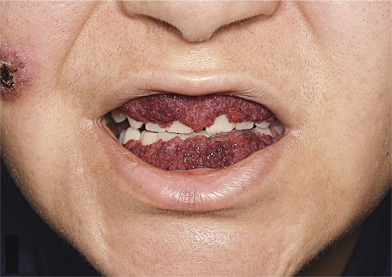 A 42-year-old woman was diagnosed with granulomatosis with polyangiitis. It’s a disorder which causes blood vessels to inflame. Source: New England Journal of Medicine 