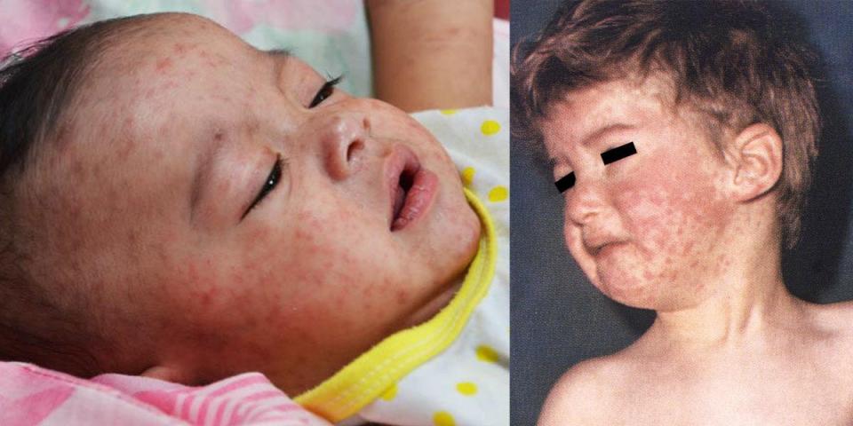 two young kids with red measles rashes on their faces