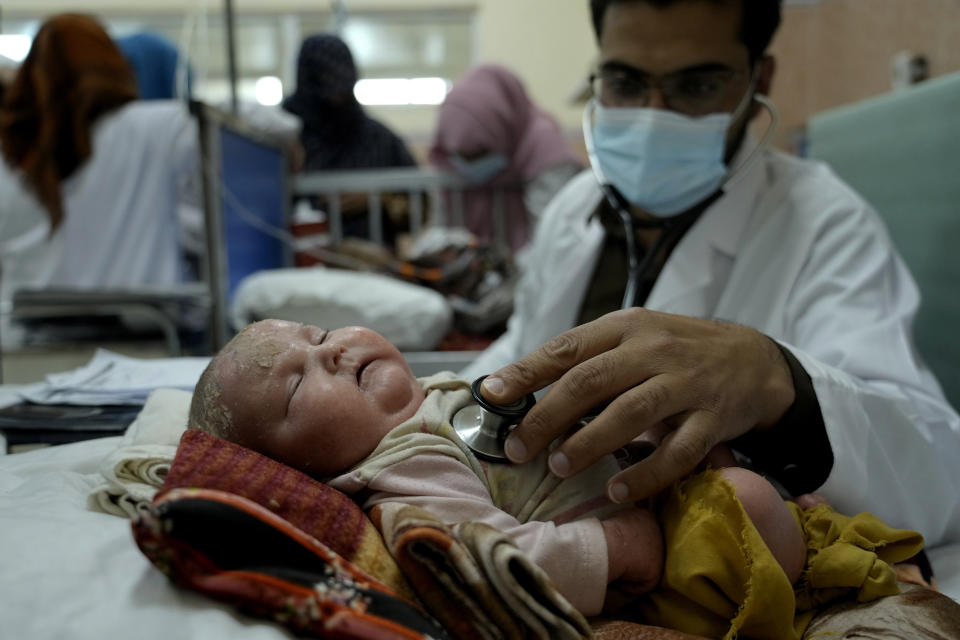 A doctor examines a malnourished child in he Indira Gandhi hospital in Kabul, Afghanistan, Sunday, May 22, 2022. Some 1.1 million Afghan children under the age of five will face malnutrition by the end of the year. , as hospitals wards are already packed with sick children . (AP Photo/Ebrahim Noroozi)