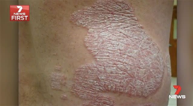 Chronic skin condition psoriasis. Picture: 7 News