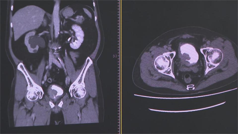 年約4千人罹「泌尿道上皮癌」　手術後選擇「免疫療法」可降低復發