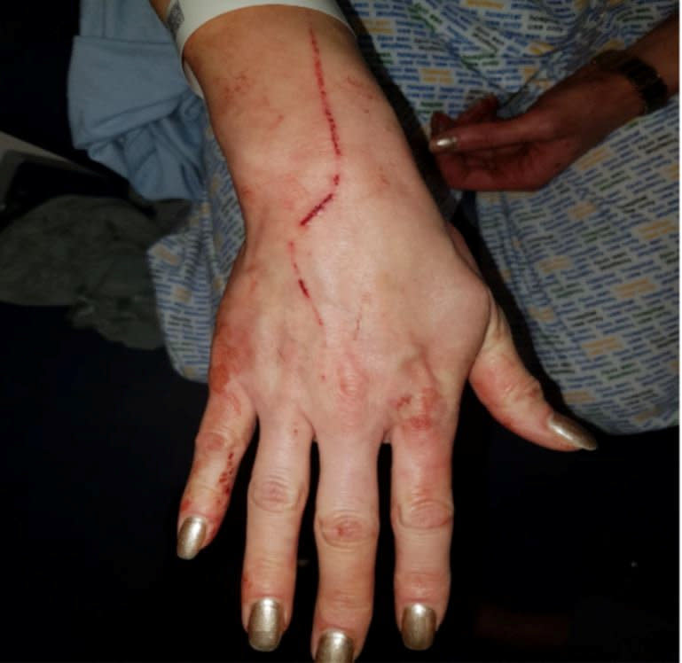 Anna suffered injuries to her hands, arms and face. (SWNS)