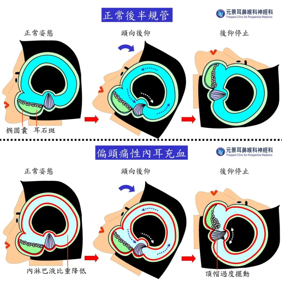 上3圖，以後半規管為例，正常人頭向後仰及後仰停止時，內淋巴液流動與壺腹內頂帽擺動、停止情形。下3圖，偏頭痛發作，內淋巴液比重變輕、不黏稠，後仰停止時卻仍流動，頂帽產生多餘的擺動。（醫師陳建志提供）