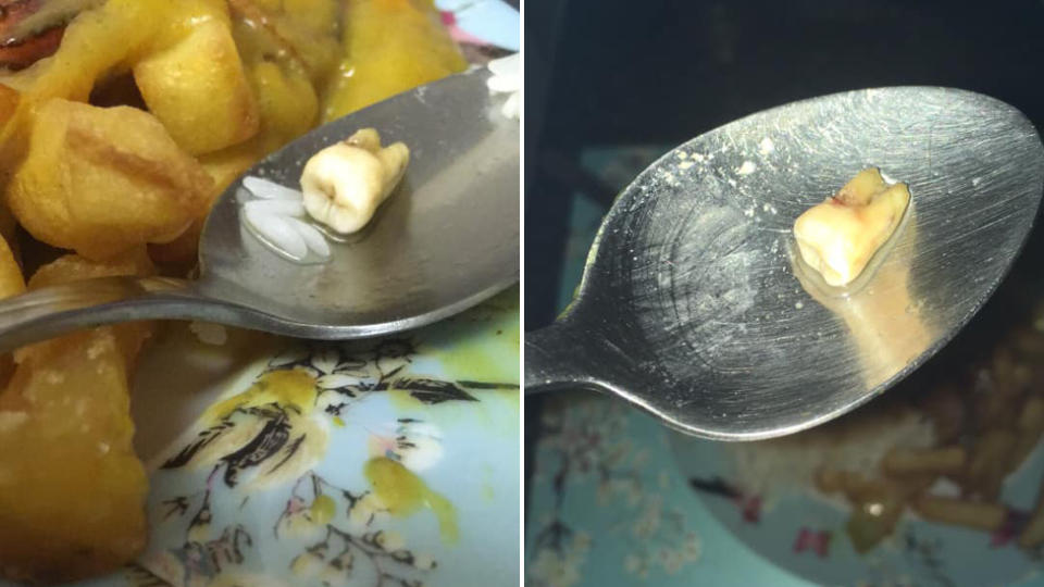 Images of what looks like s human tooth found in a Chinese take away meal.