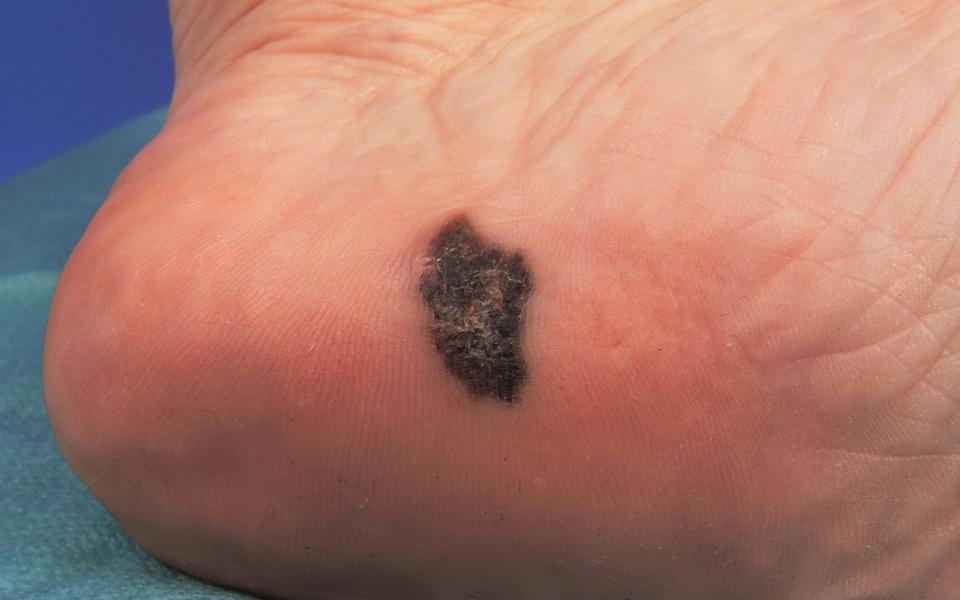 Acral melanoma appears on the palms of the hands, soles of the feet or under fingernails or toenails