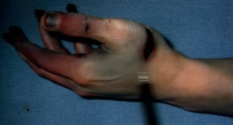 The prosecution contends this photo, shown in court on Jan. 8, 2013, shows Travis Alexander had multiple self-defense wounds to his palms and fingers that indicate he had fought for his life during the knife attack.