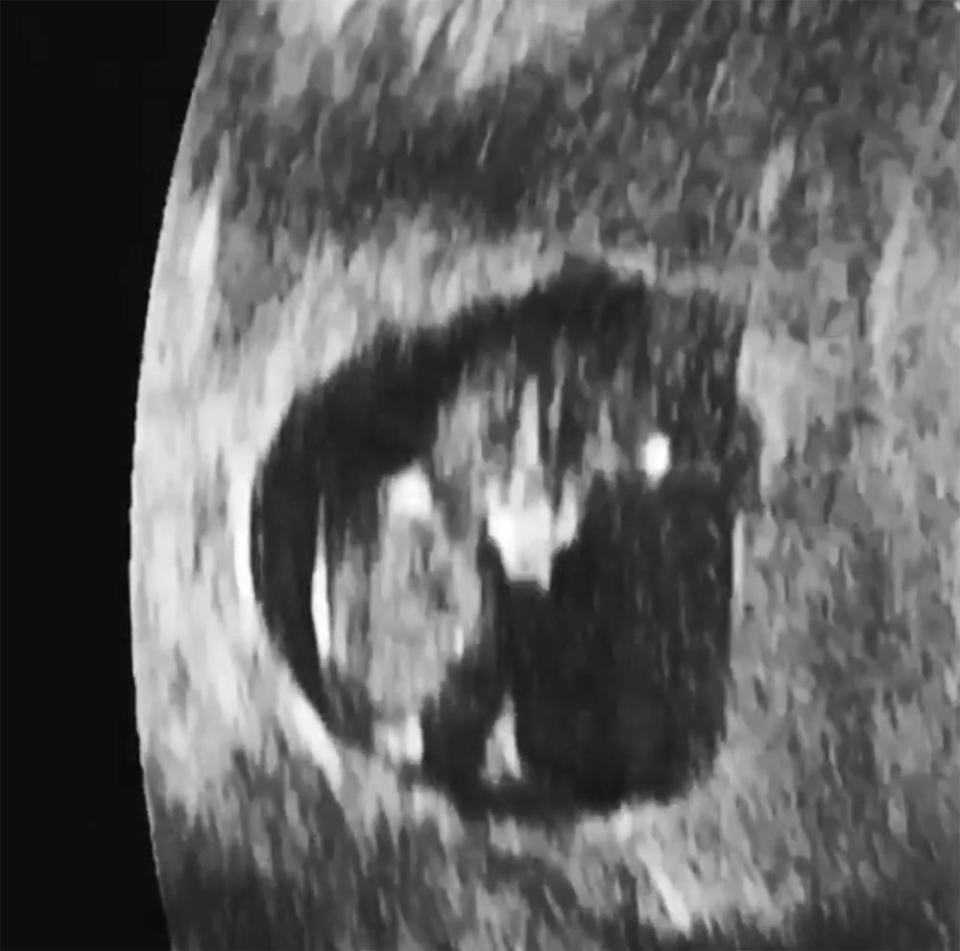 Amy Schumer Shares Ultrasound Video of Her Baby