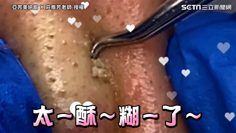 塞在毛孔裡的「閉鎖性粉刺」與已經冒出皮膚表層的「黑頭粉刺」，處理方式不同。（圖／亞芳美妍館X莊雅芳老師　授權）