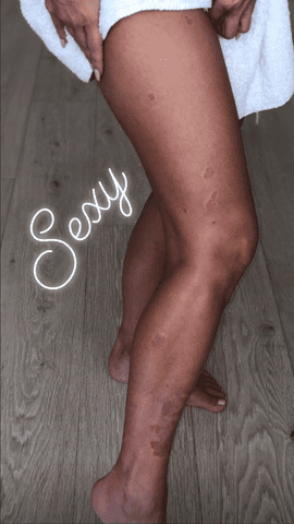 Kim Kardashian/Instagram Kim Kardashian has shared images of psoriasis flares in the past.