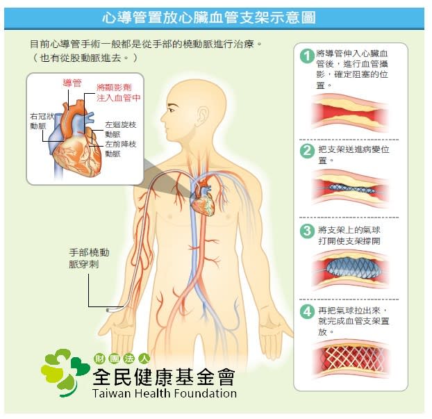 心導管置放心臟血管支架示意圖