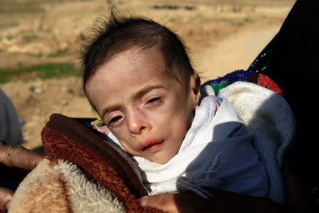 A 5-months-old child suffering from dehydration, Batoul Bashir Ahmad, is carried by his mother, an Iraqi displaced woman who fled her home during a battle between Iraqi forces and Islamic State militants, in Mosul, Iraq March 9, 2017. REUTERS/Thaier Al-Sudani