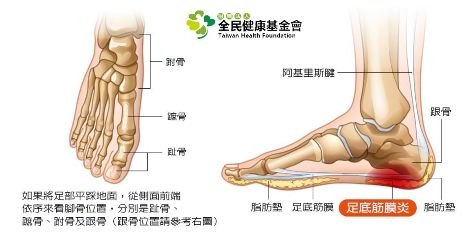 足底筋膜炎示意圖