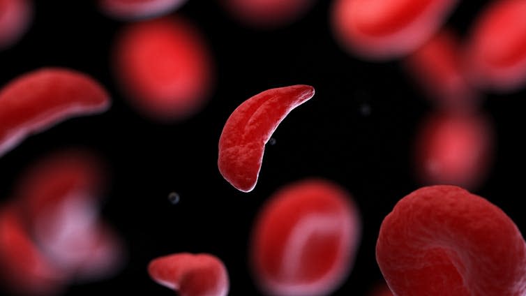 A digital picture of a sickle-shaped red blood cell, which occurs in people with sickle cell disease.