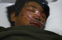 Dawa Tashi Sherpa lies on the bed of the Intensive Care Unit at Grandi International Hospital after he was rescued and airlifted from the avalanche site at Mount Everest in Kathmandu April 18, 2014. (REUTERS/Navesh Chitrakar)