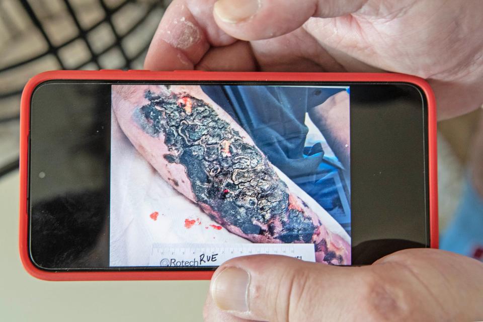 Anthony shows a photo of his injured arm during an interview at his mother's home in Lewes, Thursday, Sept. 7, 2023. Anthony, who has struggled with addiction for the last nearly 15 years, recently almost lost both arms due to xylazine, known as "tranq dope."