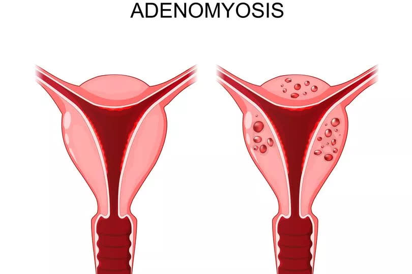 Adenomyosis. Comparison and difference between normal and unhealthy abnormal uterus. female reproductive system. medical condition when cells endometrium atypically located among the cells of the uterine myometrium. This tissue sheds and bleeds during every menstrual cycle. Vector illustration.