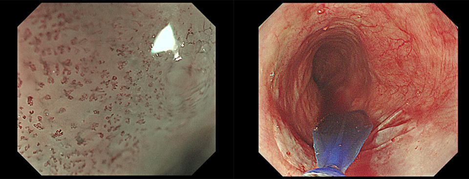 (左圖)內視鏡檢查發現食道有異常的微血管。(右圖) 透過「內視鏡熱射頻燒灼術」治療早期食道癌。