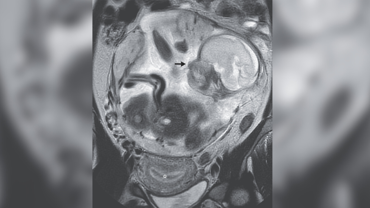  MRI scan of a woman's abdomen shows a black arrow pointing at the outlined head of a fetus. 