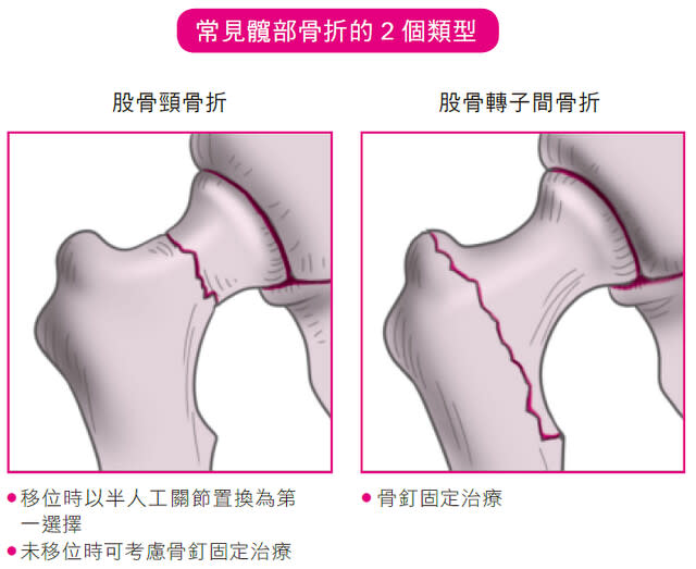 常見髖部骨折的2個類型