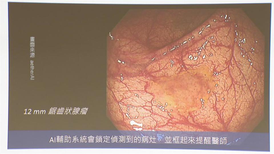 全新「AI　瘜肉偵測系統」　早期發現治療大腸癌