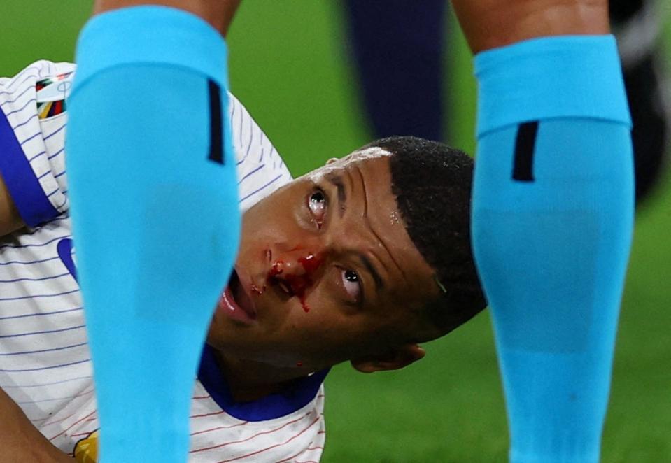 Kylian Mbappe was left bloodied in the win over Austria (REUTERS)