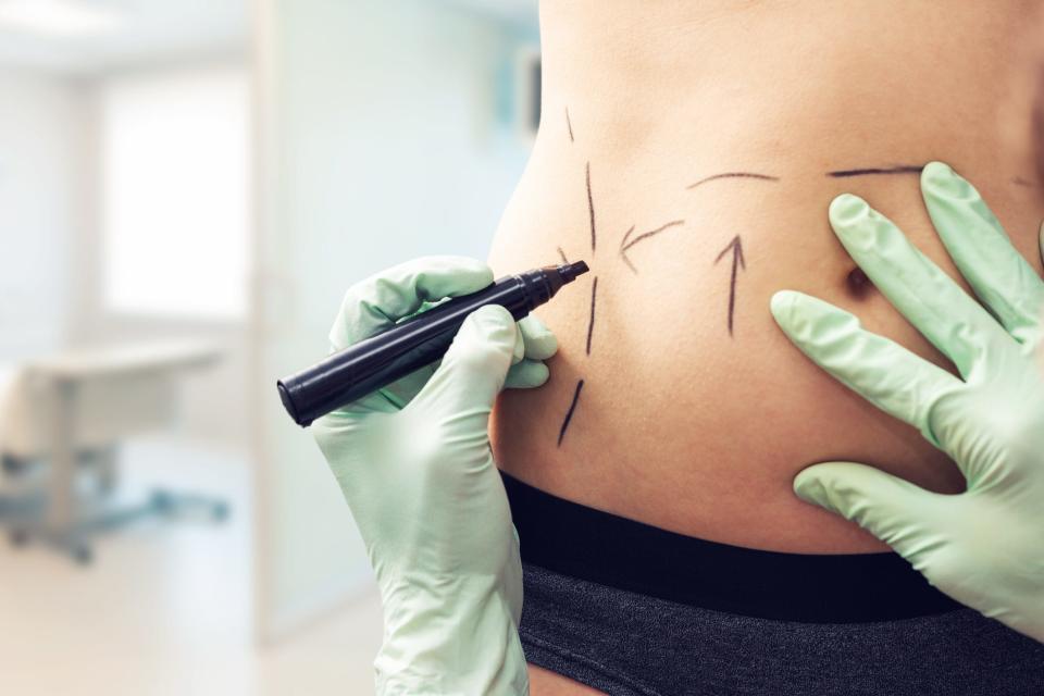 Plastic surgeon marking woman's body for surgery.
