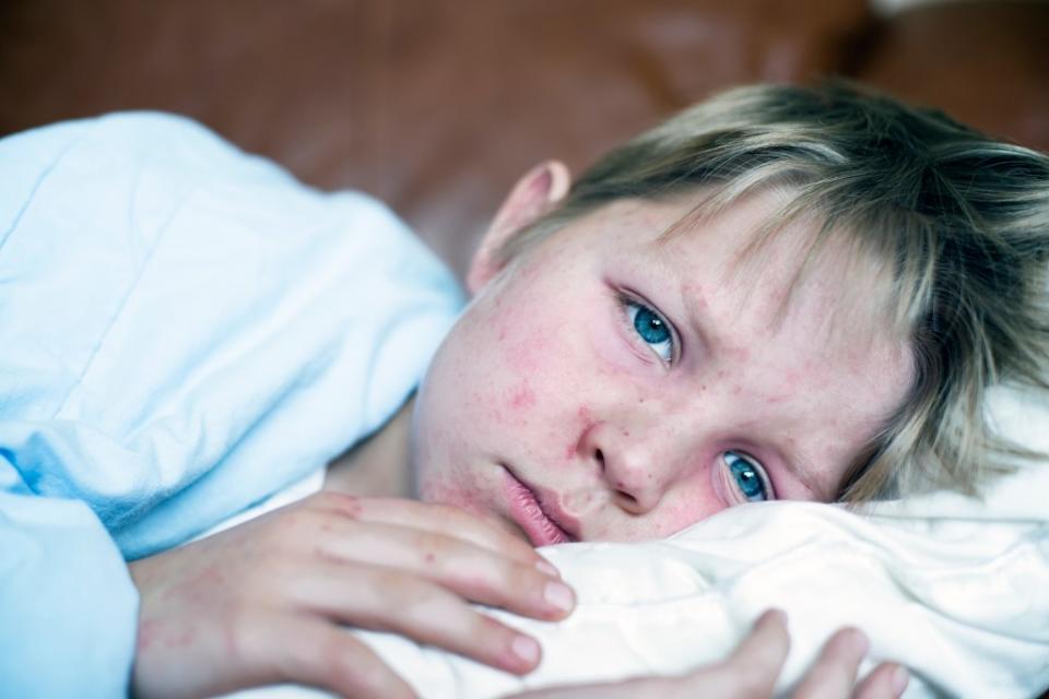 Florida has the largest outbreak at the moment with 10 reported cases — six of them linked to one elementary school in Broward County. Getty Images