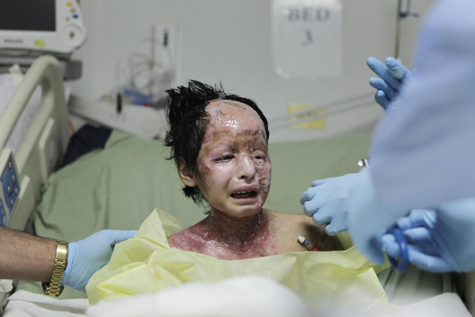 FILE - In this June 9, 2009 file photo, doctors treat eight-year old Razia after she was severely burned when a white phosphorus round hit her home in the Tagab Valley during fighting between French troops and Taliban militants, at the U.S. military hospital in Bagram Air Base, north of Kabul, Afghanistan. A new report by Human Rights Watch and Harvard's human rights clinic released on Monday, Nov. 9, 2020, has documented the use of incendiary weapons and their horrific human cost on civilians over the past decade in conflict zones like Afghanistan, the Gaza Strip and Syria. (AP Photo/Rafiq Maqbool)