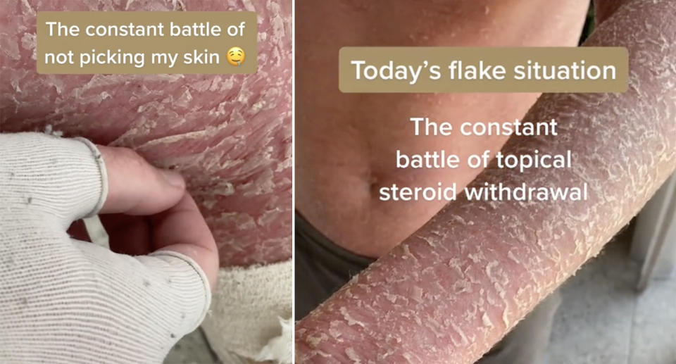 Jordan Hendey's skin is peeling due to topical steroid withdrawal