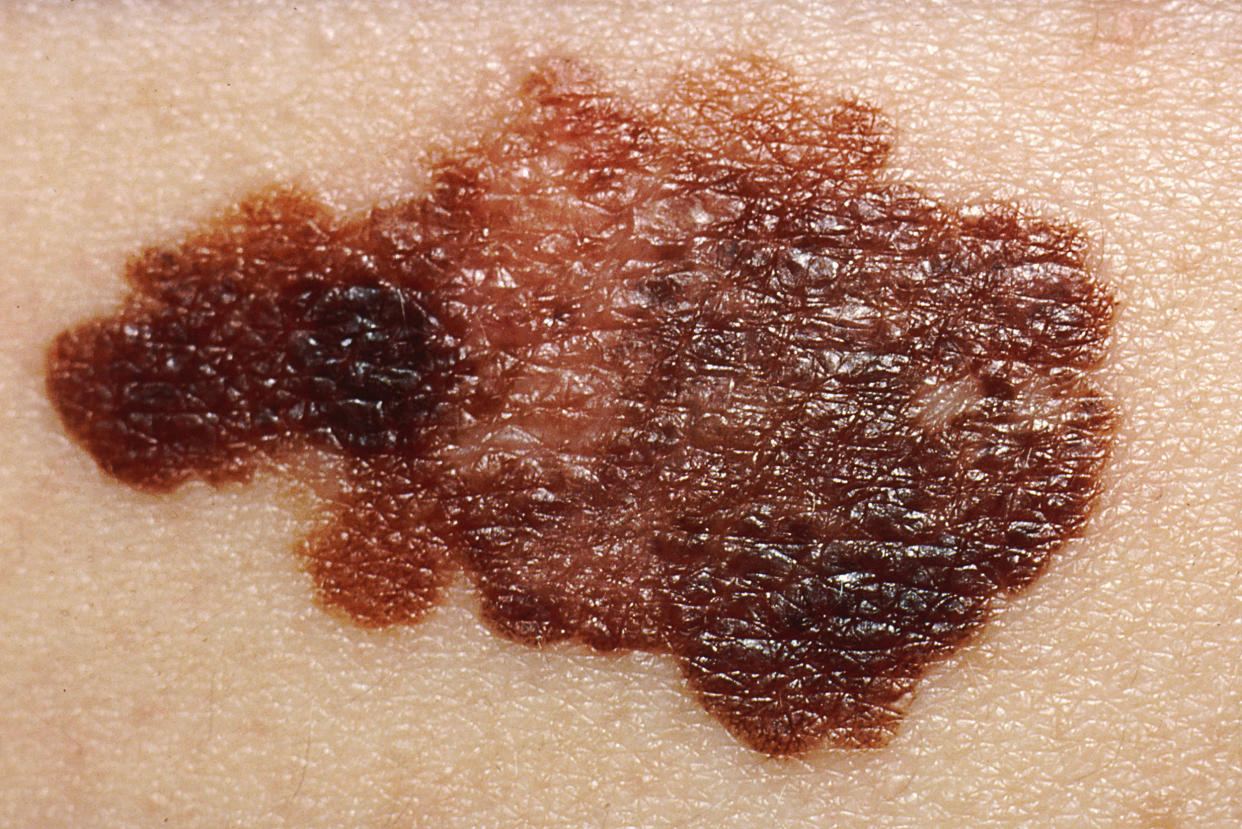 What does melanoma look like and is melanoma skin cancer (Callista Images / Getty Images stock)