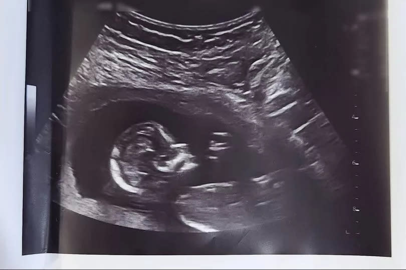 The baby scan of Michael McGoldrick and Diana Palacios's baby that Michael's sister Caoimhe correctly predicted in her dream.