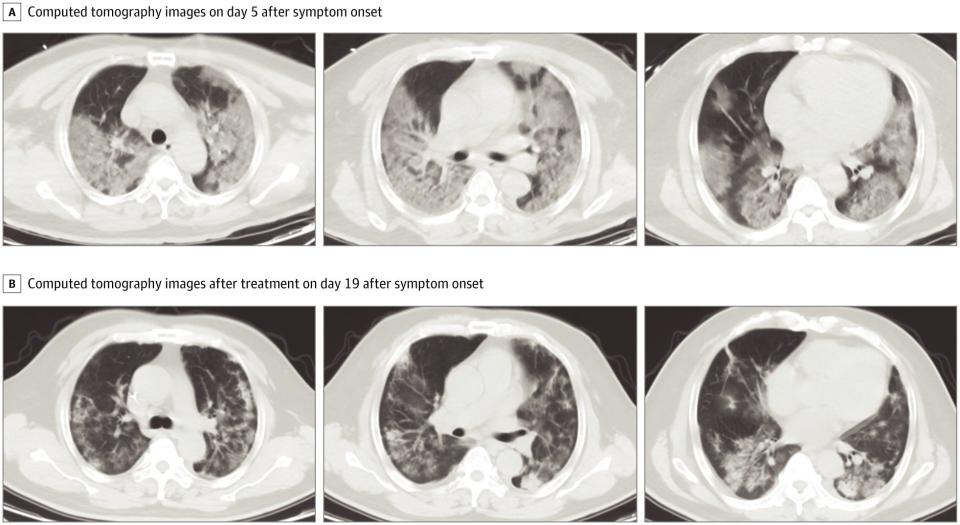 JAMA coronavirus scans