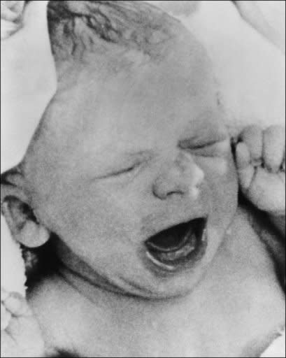 Louise Brown, the world's first IVF baby is seen July 26, 1978 after she was delivered by Caesarean section at Oldham District General Hospital, Greater Manchester