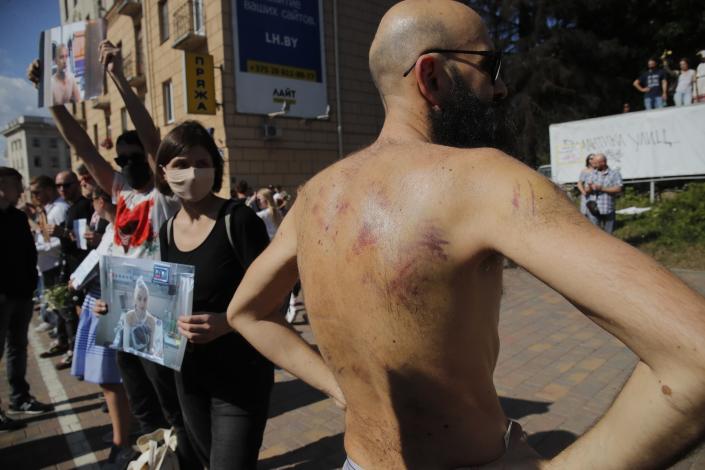 A man released from detention shows bruises he says were from a police beating, as others hold pictures of their beaten relatives and friends during a rally in Minsk, Belarus, Saturday, Aug. 15, 2020. Thousands of demonstrators have gathered at the spot in Belarus' capital where a protester died in clashes with police, calling for authoritarian President Alexander Lukashenko to resign. (AP Photo/Dmitri Lovetsky)