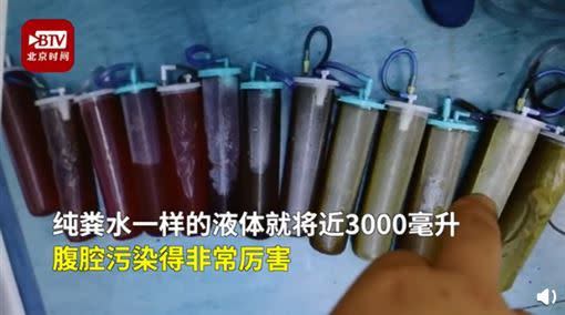 腹腔抽出3000毫升的糞水。（圖／翻攝自北京時間）