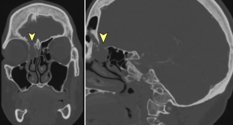 A CT scan from 2017 shows a woman's brain.