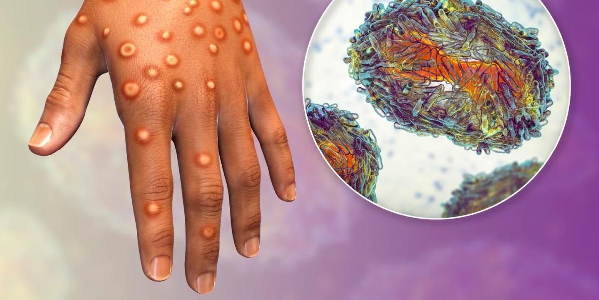 What is Mpox? Everything you need to know about 2024 Monkeypox outbreak