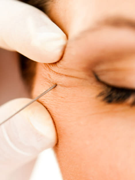 botox injection around eye 