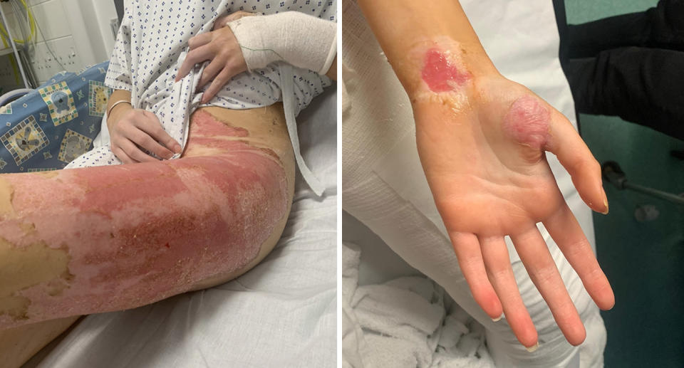 Burns from burst hot water bottle on leg and hand