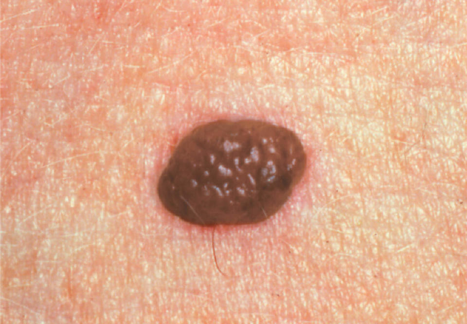 picture of benign mole irregular border (Courtesy The Skin Cancer Foundation)