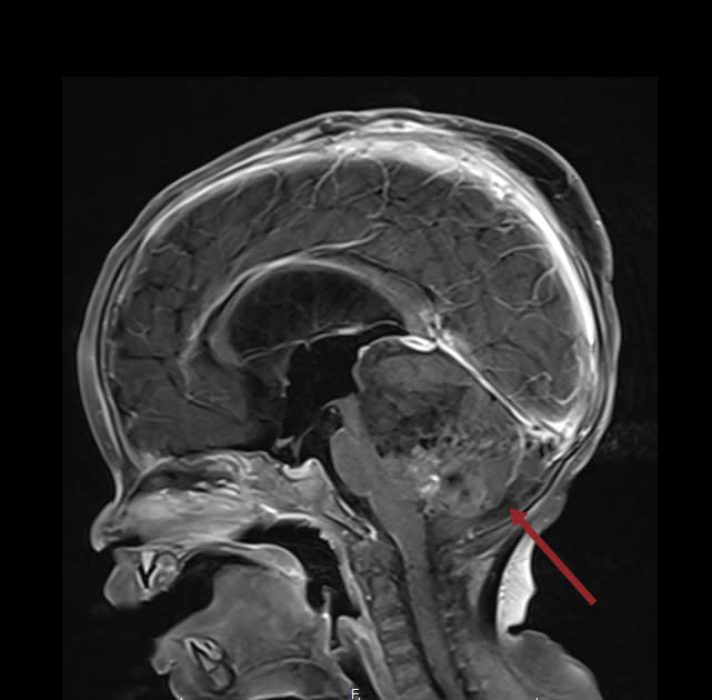 非典型畸胎橫紋肌樣瘤(ATRT)」是非常罕見的惡性腦瘤，台灣平均２年約有２例，而台北癌症中心收治的患者確診時僅9個月大，當時腫瘤幾乎佔滿病童的後顱窩的中央部分。   圖：台北醫學大學／提供