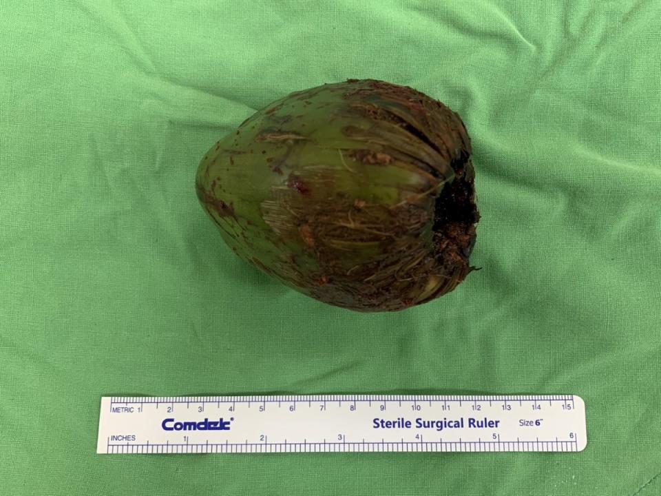 高雄一名56歲男子將這顆7.5X5.7X5.5公分大小的椰子塞進肛門導致嚴重腹痛，無法解尿排便，醫師開刀取出。（圖：義大醫院提供）