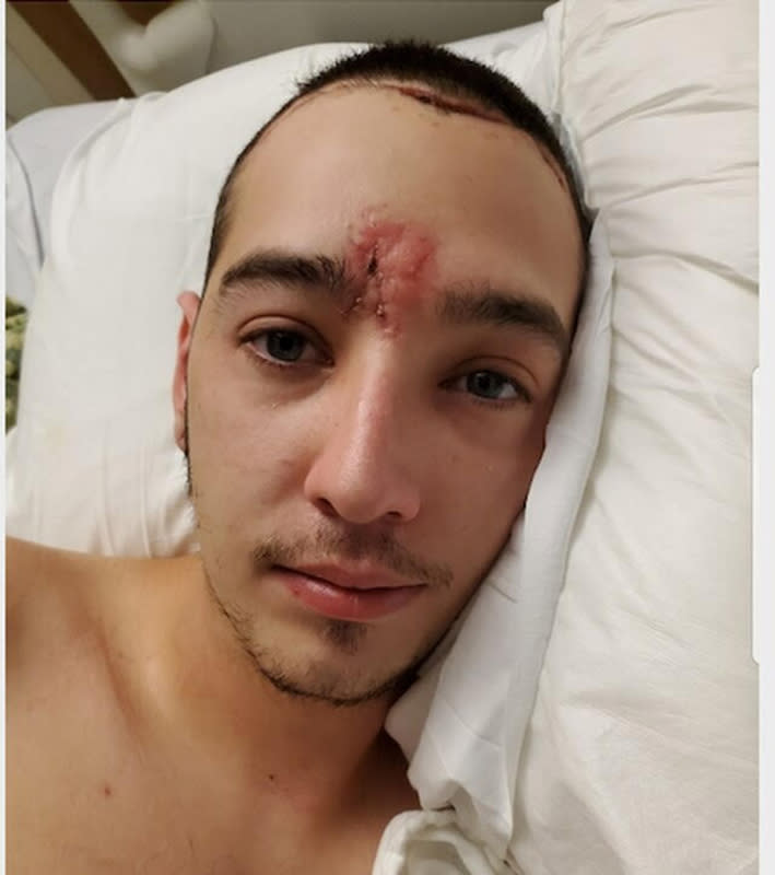 Donavan La Bella was shot with impact munition at a protest in Portland, Ore., on July 11, fracturing his skull and breaking the bones around his left eye socket.<span class="copyright">Courtesy the La Bella Family</span>